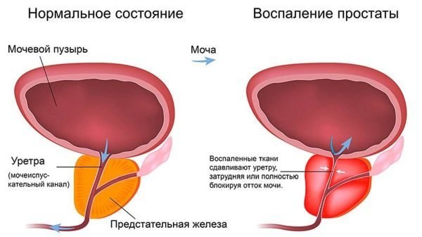 Простатит