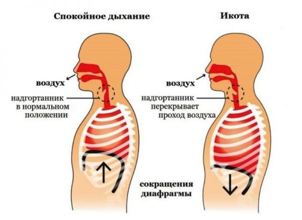 Схематическое изображение икоты