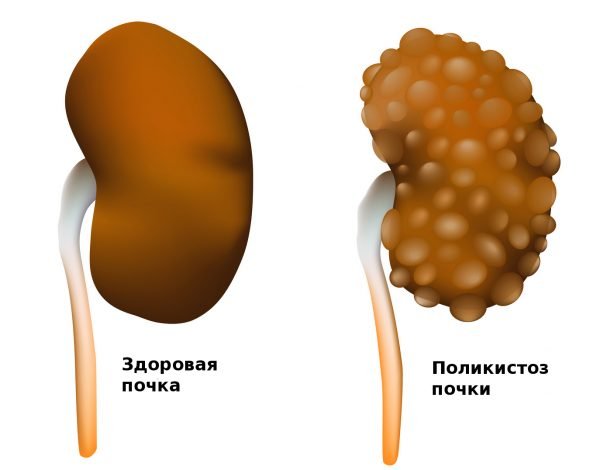 Поликистоз почки