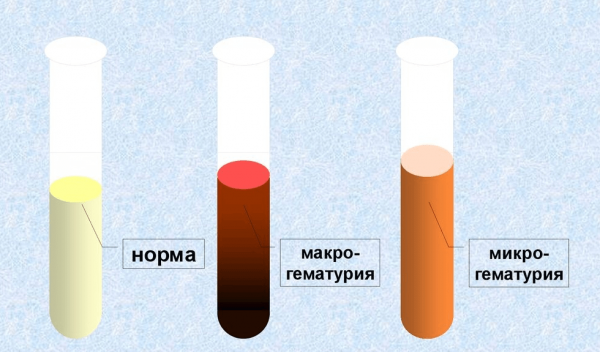 Макро- и микрогематурия