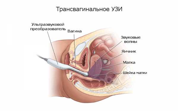 Трансвагинальное УЗИ