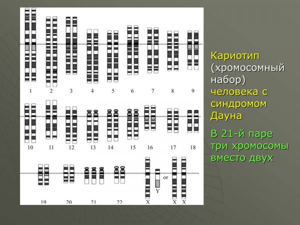 Кариотип человека при синдроме Дауна